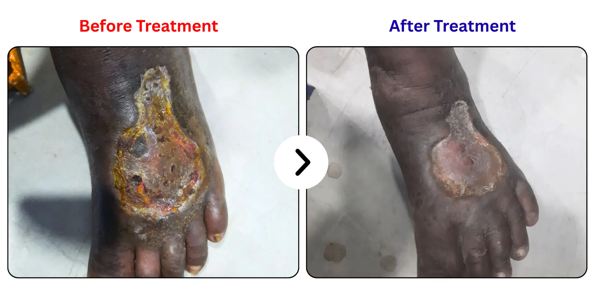 Varicose leg ulcer