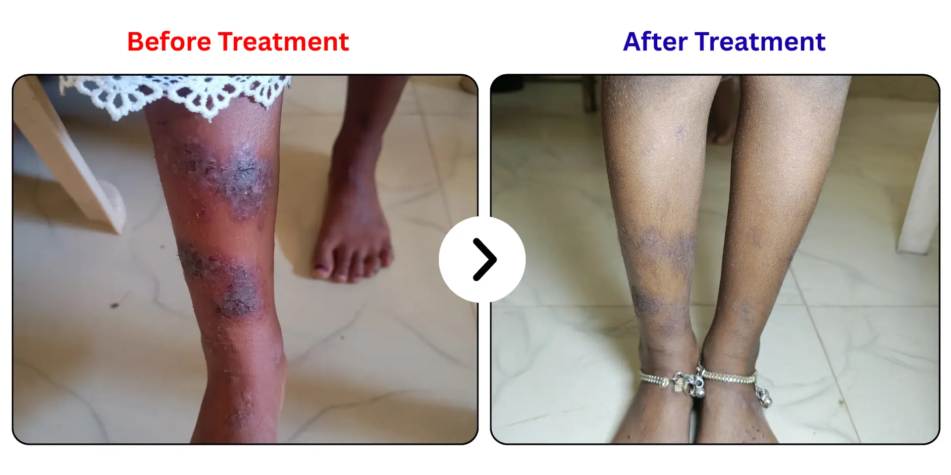 Multiple skin ulcers